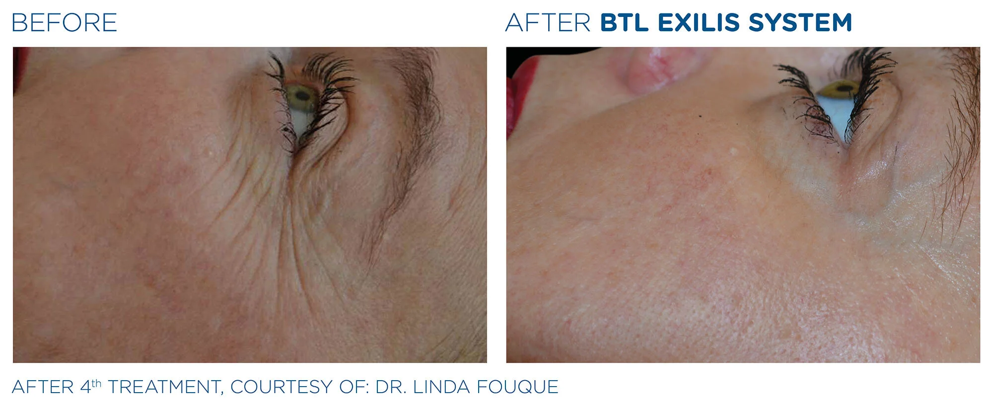 EXILIS Ultra 360 | Skin Tightening | Fat Reduction — Rejuve
